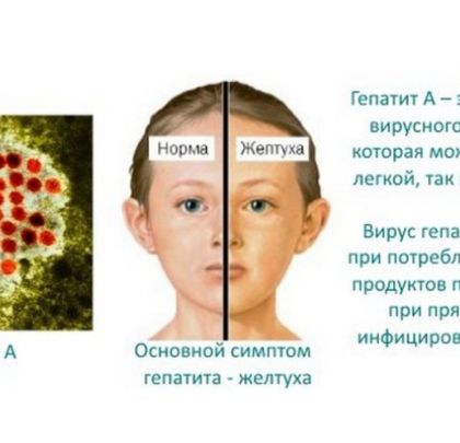 Гепатит А: як передається, симптоми та профілактика 